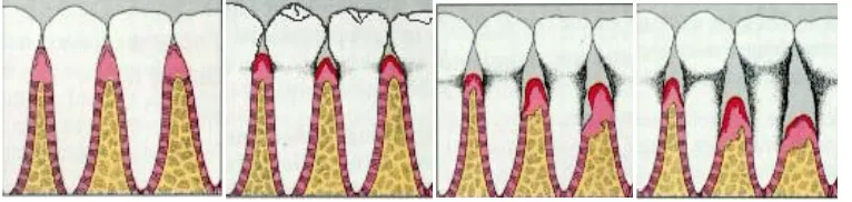 Gambar 5. Penurunan tulang alveolar dan kehilangan perlekatan 