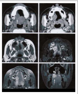 Gambar 3.13 :    Adenoma Pleomorfik di palatum laki-laki, 59 tahun. Pinggir  tumor, batas tumor,dan resorpsi tulang dapat di deteksi dengan CT dan MRI