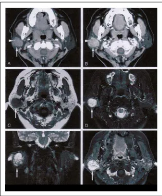 Gambar 3.14 :  Adenoma Pleomorfik pada kelenjar parotid wanita, 57 tahun. Pinggir  tumor, batas tumor di deteksi dengan CT dan MRI
