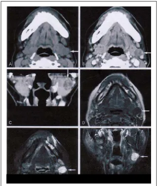 Gambar 3.15 : Adenoma Pleomorfik pada kelenjar submandibularis  wanita, 55 tahun. Pinggir  tumor, batas tumor di deteksi dengan CT dan MRI