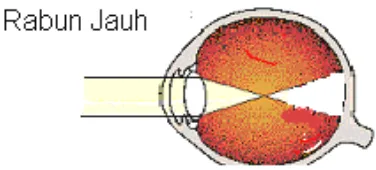 Gambar 20.  Pembiasan cahaya pada mata hipermetropi (rabun dekat)