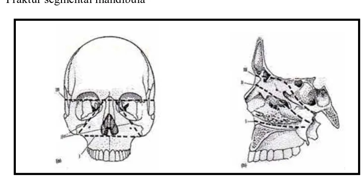 Gambar 2. Fraktur pada daerah mandibula A. Dento-alveolar B. Kondilar C. Koronoid D. Ramus E