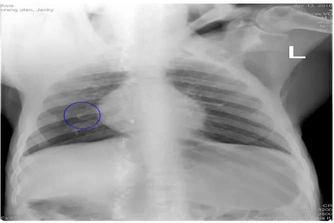 Gambar 3.2 Foto x-ray thorax