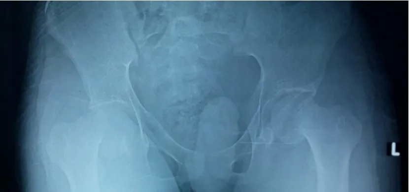 Gambar 1: X-ray 28 Mey Identifiksai SCFE pertama