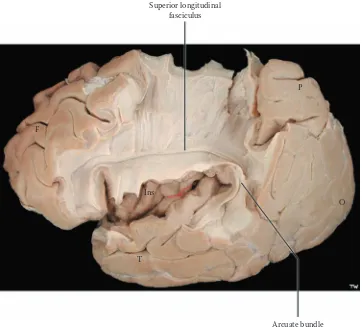 FIGURE 19B: Cerebral Hemispheres 10 — Lateral Dissected View: Association Bundles (photograph)