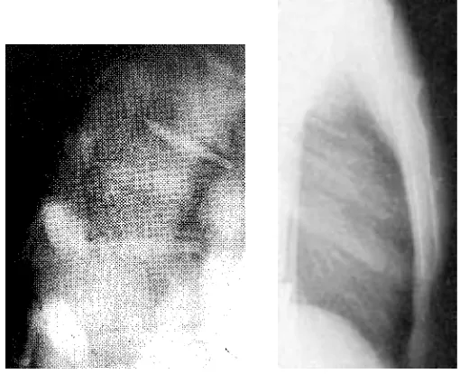 Figure 6.9 Lateral CT (scanogram) showing wedge compressionfracture of L1 with incomplete paraplegia; axial view on CT showingcanal encroachment and pedicular widening; after transpedicularfixation with restoration of vertebral height and alignment.