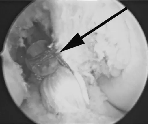 Figure 6.60. The Endopearl and hamstring graft passage.