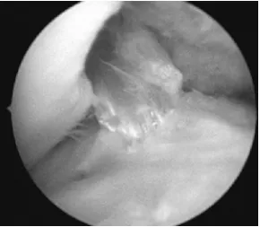 Figure 7.17. The completed patellar tendon graft.