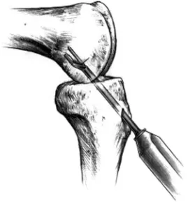 Figure 9.15. The femoral aiming device.
