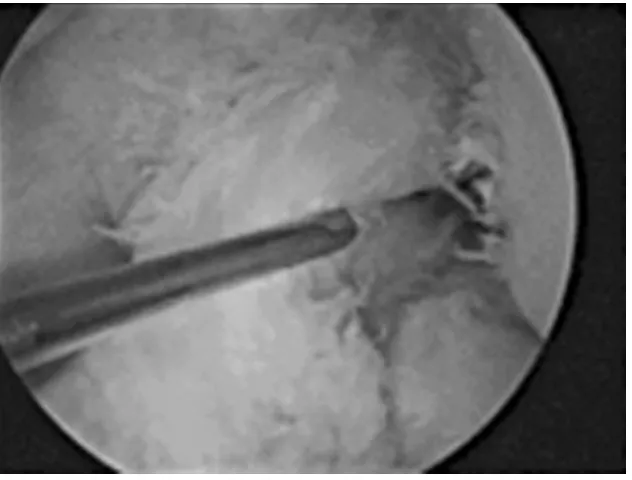 Figure 3.3. The laxity of the ACL is demonstrated with a probe.