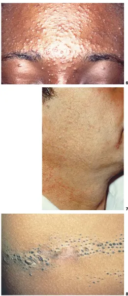Fig. 6. Pomade acne.Fig. 7. Chloracne.Fig. 8. Naevoid acne.