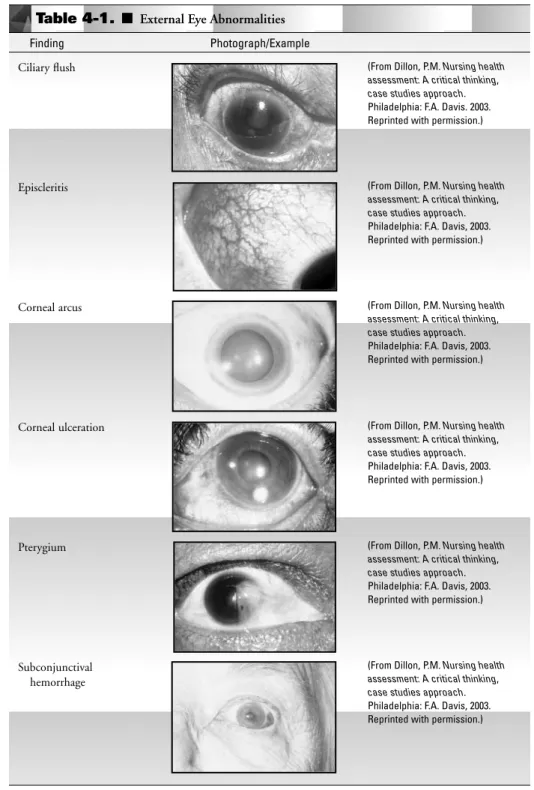 Table 4-1. ■ External Eye Abnormalities Finding Photograph/Example Ciliary ﬂush Episcleritis Corneal arcus Corneal ulceration Pterygium Subconjunctival  hemorrhage