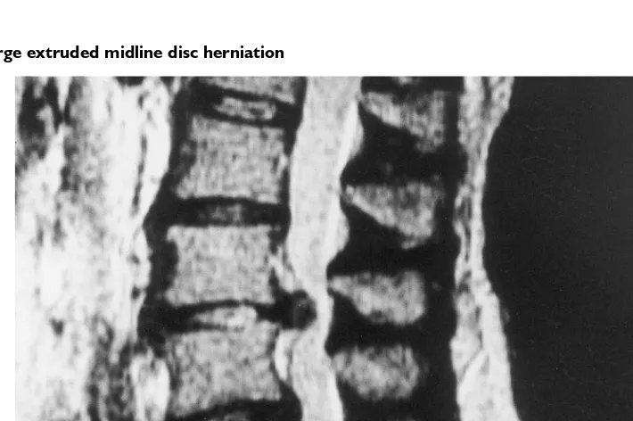 Figure 4.5 Large extruded midline disc herniation