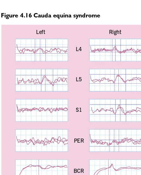 Figure 4.15 Chronic electromyographic potentials