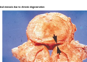 Figure 5.1 Spinal stenosis due to chronic degeneration