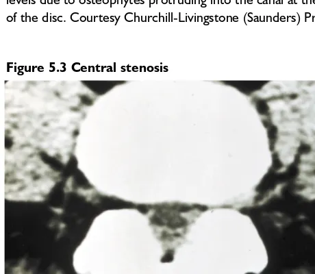 Figure 5.3 Central stenosis