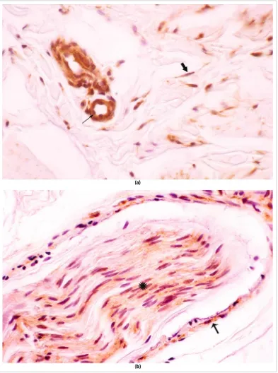 Figure 3.13. VEGF is present in small vessels (wall and endothelium) (thin arrow) and in perivascular fibroblasts (thick arrow) in patients with mod-erate-severe pain (a)