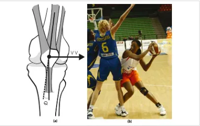 Figure 4.10. Excessive wear of the lateral heel area of the shoe means a heel varus and is very frequent to the production of lateral knee pain