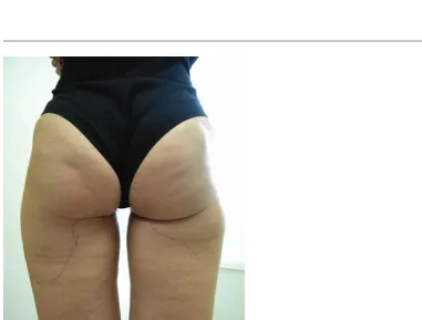 Figure 2Areas commonly affected by cellulite