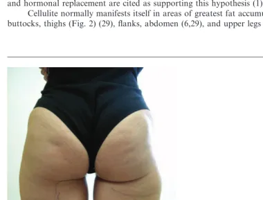 Figure 2Areas commonly affected by cellulite