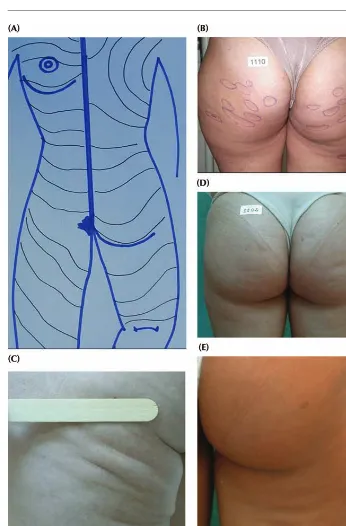 Figure 4(A) Relaxed skin tension lines mapped on a body scheme. The left half shows the frontal view and
