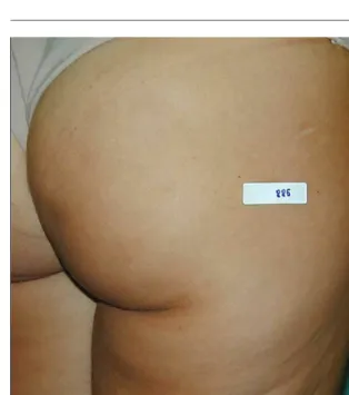 Figure 6‘‘Orange peel’’ or ‘‘mattress’’ appearance of second degree cellulite.