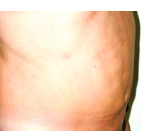 Figure 13Macroscopic aspect of subcutaneous fat from a corpse.