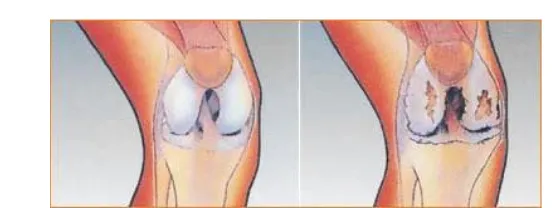 Gambar  4.  Sendi  lutut  normal  dan  sendi  lutut  yang  terserang