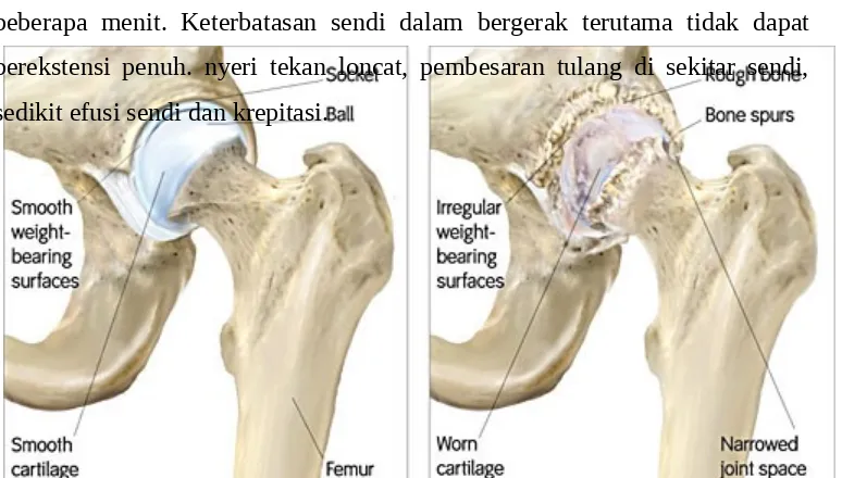 Gambar 6. Osteoarthritis pada sendi panggul (hip joint)