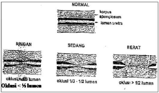 Gambar 2.4 Derajat Penyempitan Urethra (Purnomo, 2003)