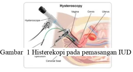 Gambar  1 Histerekopi pada pemasangan IUD
