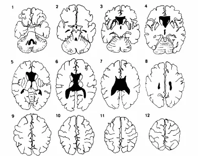 Gambar 3: Head CT Scan Territori Anterior Cerebral Artery Axial section 