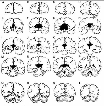 Gambar 4: Head CT Scan Territori Anterior Cerebral Artery coronal section 