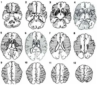 Gambar 7: Gambaran Head CT Scan Territori Middle Cerebral Artery Axial section 