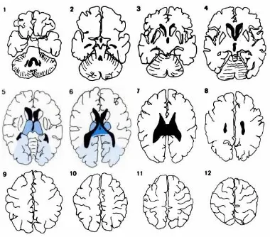 Gambar 11: Head CT Scan Territori Posterior Cerebral Artery Axial section 
