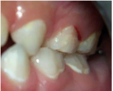 Gambar 2 Anak berusia tiga tahun, dengan risiko karies yang tinggi. Terdapatnya plak gigi yangterlihat, perdarahan gingiva dan lesi white spot pada servikal gigi posterior