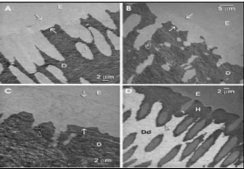Gambar 6. Mikrograf   TEM  dentin  intraradikuler yang diirigasi dengan NaOCl 2,6% dan EDTA    17%     (a)    bagian     koronal  undemineralisasi   dentin ,  smear  layer   dibuang , 4 - 5 μm  zona  demineralisasi  dentin (antara anak panah) di sepanjang  permukaan  dinding  dentin, demineral- isasi   mengelilingi    permukan   bawah    tubulus   dentin   terlihat   jelas  (panah) (b) bagian tengah,lapisan demineralisasi (5 μm) di sepanjang  permukaan  dentin (antara panah),   cabang  lateral  tubulus dentin (pointer) (c) bagian apikal,  8 μm zona demineralisasi (antara anak panah) tubulus dentin jarang, sesekali  sklerotik  (panah)    (d)  demineralisasi   in -  situ ,  infiltrasi  EDTA    membentuk    lapisan    hybrid 5-6μm(H), lapisan hybrid berada   di permukaan  perifer tubulus (panah).14 