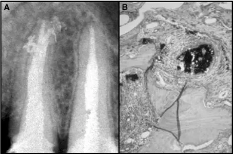 Gambar 1: bahan pengisi saluran akar menonjol dari ramifikasi ruang pulpa untuk kemudian bertemu denganjaringan vital pada membran periodontal dan tulang