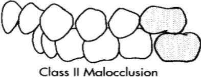 Gambar 3.Maloklusi kelas III