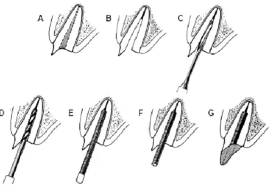 Gambar 8. Penempatan parallel para-post dan composite resin core pada gigi