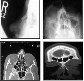 Gambar 6. Foto nasal lateral3, Foto Water’s, dan CT scan potongan aksial 
