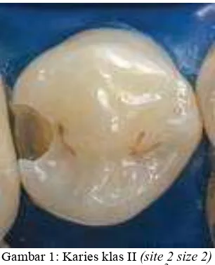 Gambar 1: Karies klas II  (site 2 size 2) pada gigi premolar2 