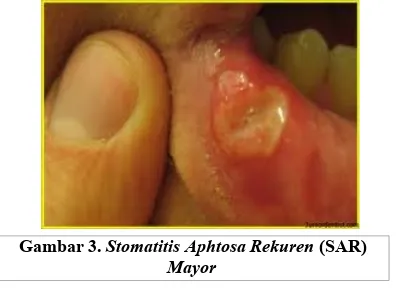 Gambar 3. Stomatitis Aphtosa Rekuren (SAR)