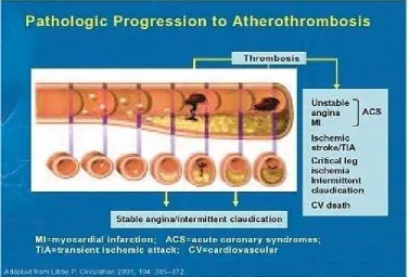 Gambar 6. Progresi Patologis  Aterotrombosis 