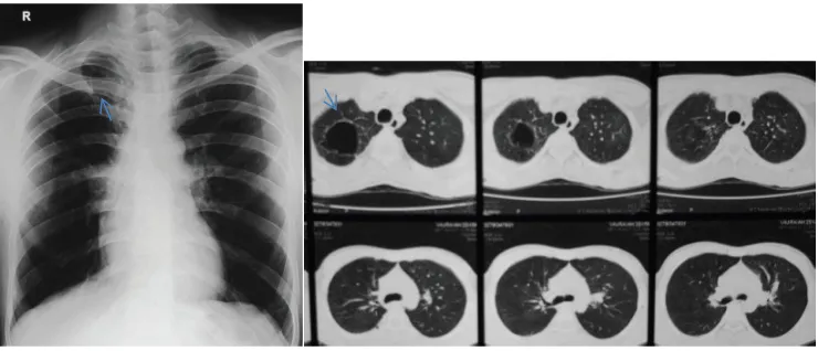 Gambar  3.  Foto  toraks  PA  dan  CT  scan  toraks  yang  menunjukkan  kavitas