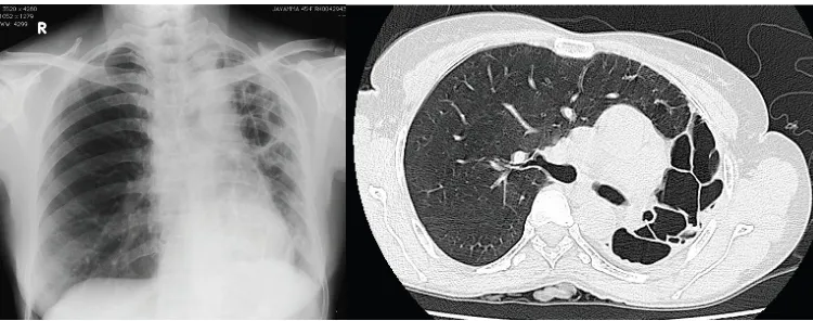 Gambar 5. Foto toraks PA dan CT scan toraks menunjukkan destruksi paru