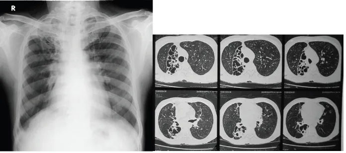 Gambar 5. Foto polos paru PA dan CT scan toraks menunjukkan bronkiektasislobus paru kanan