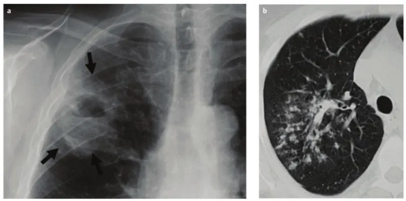 Gambar 6. Gambaran radiologis infeksi TB pada paru.