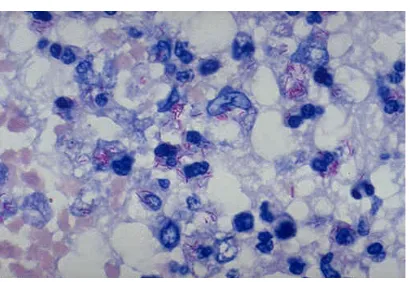 Gambar 2. Gambaran mikroskopik M. Tuberculosis dengan Pewarnaan Ziehl Neelsen