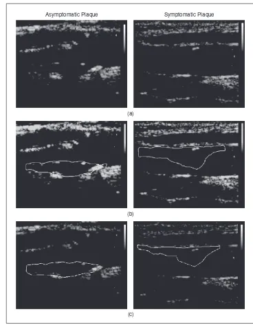 Fig. 1. Segmentation of atherosclerotic carotid plaque in asymptomatic (left column) and symp-tomatic (right column) cases using manual and automated segmentation